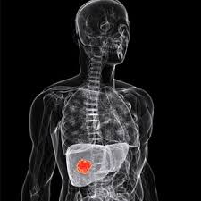 Liver Cancer Treatment