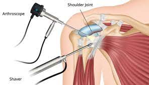 Shoulder Arthroscopy