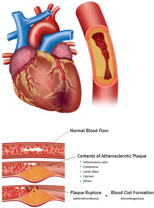 CTO (Chronic Total Occlusion Coronary Intervention)