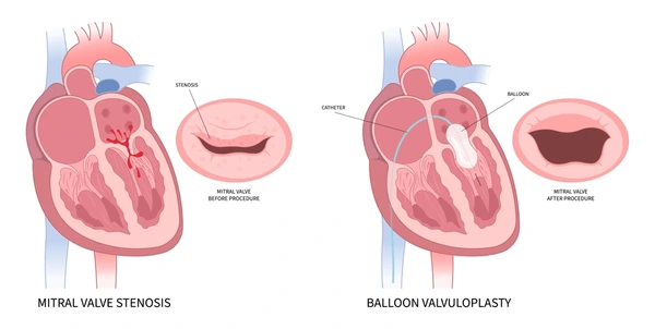 Balloon Mitral Valvuloplasty